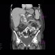 Chronic pancreatitis, dilated pancreatic duct: CT - Computed tomography